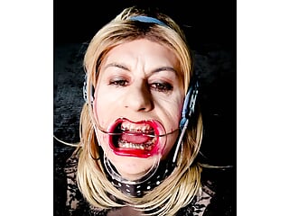 Extreme braces headgear and open mouth expander fetish