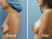 Dual Plane Breast  b4 and after